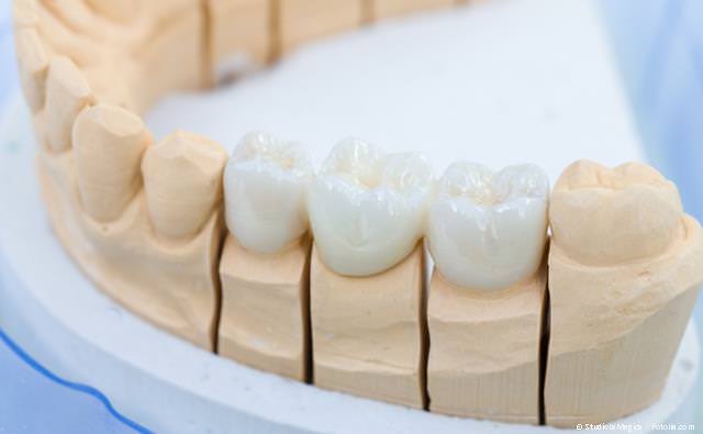 Zahnbrücke aus reiner Keramik